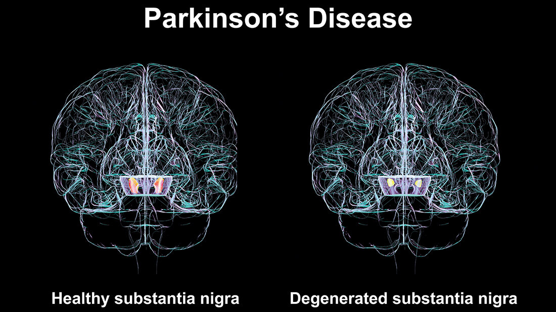 Vergleich gesunder mit degenerierter Substantia nigra 