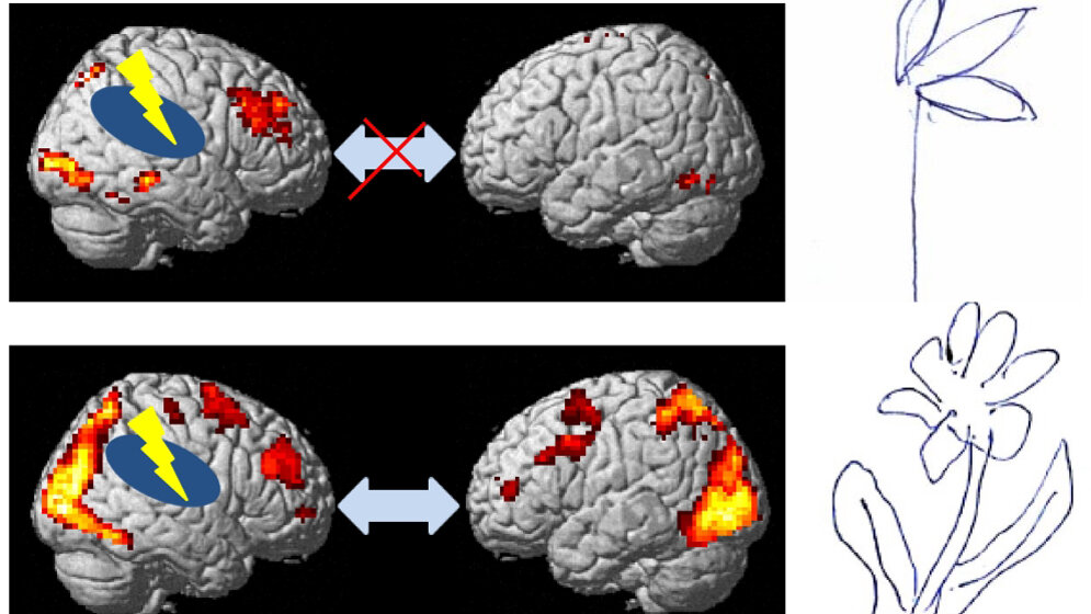 Ein Schlaganfall führt häufig zu einer räumlichen Wahrnehmungsstörung.