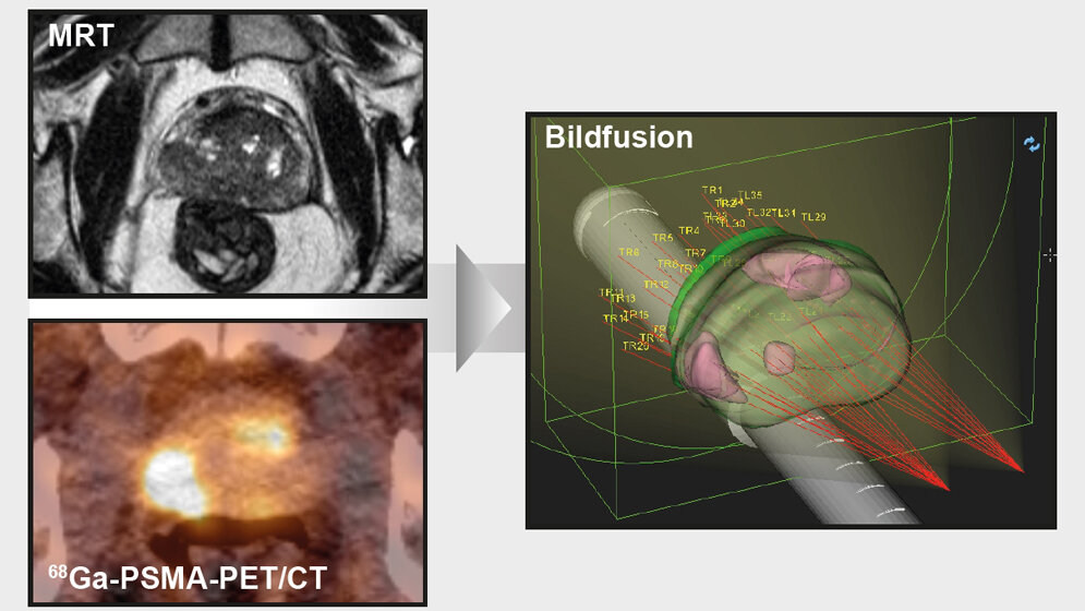 Bildgebungsmethoden mit Echtzeit-Ultraschallbild fusioniert