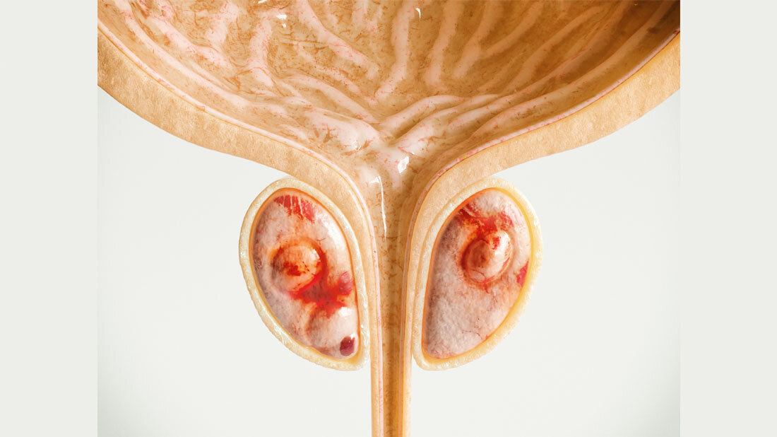 Prostatakrebs (Stadium 2 [von 4]) 