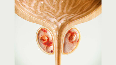 Prostatakrebs (Stadium 2 [von 4]) 