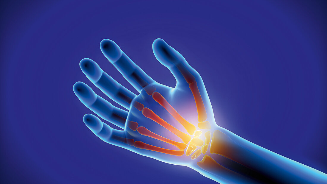 Grafik einer durchleuchteten Hand mit Hervorhebung der Handgelenkknochen