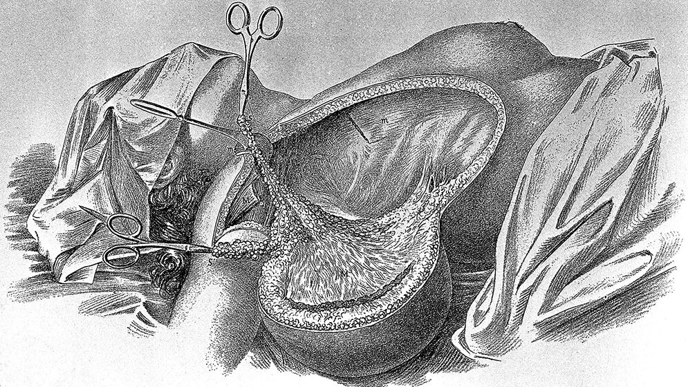 Kennen Sie William Steward Halsted?