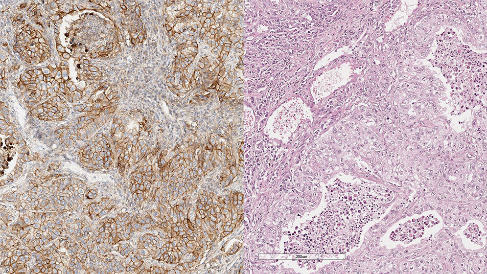 Optimierung und Validierung von PD-L1-Färbeprotokollen am Beispiel E1L3N (Teil 3)