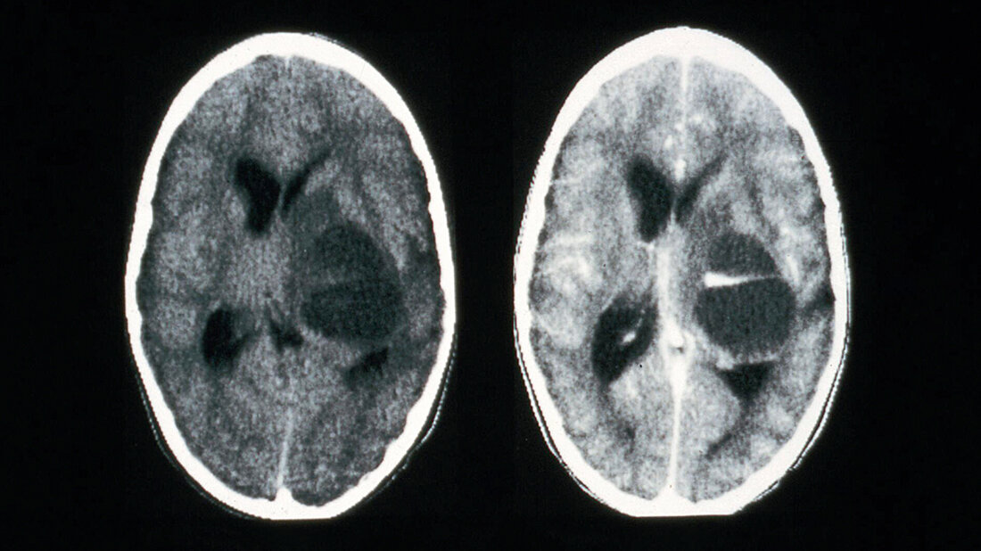 Titelbild zum Beitrag „Radiological diagnosis of head injuries with a CT-Scan“