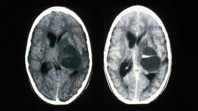 Titelbild zum Beitrag „Radiological diagnosis of head injuries with a CT-Scan“