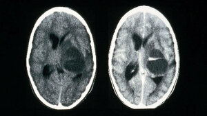Titelbild zum Beitrag „Radiological diagnosis of head injuries with a CT-Scan“