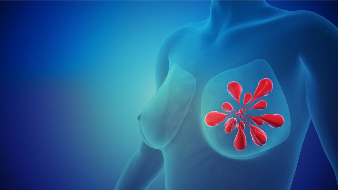 Brustkrebs_Radiodermatitis.jpg Bildliche Darstellung von Brustkrebs