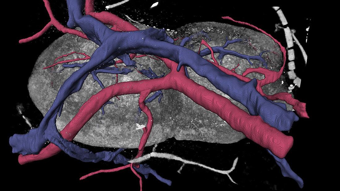 Lymphknoten.jpg Lymphknoten.jpg