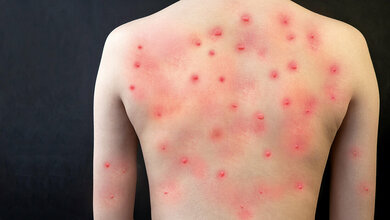 Titelfoto zum englischen Fachbeitrag über Monkeypox