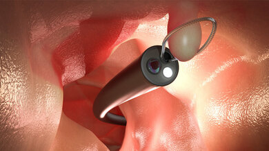 Darmkrebs verhindern