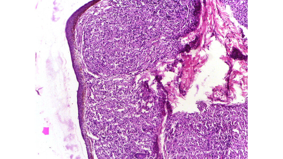Beispielhafte Hautbiopsie