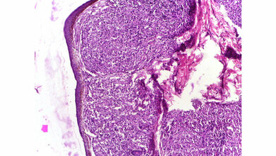 Beispielhafte Hautbiopsie