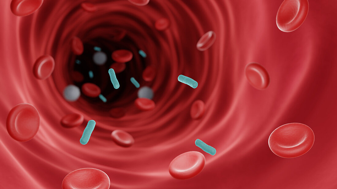 Sepsis