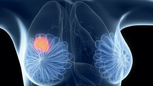 Spiegelbestimmung von Tamoxifen  und Metaboliten mittels LC-MS/MS