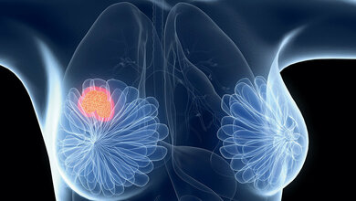 Spiegelbestimmung von Tamoxifen  und Metaboliten mittels LC-MS/MS