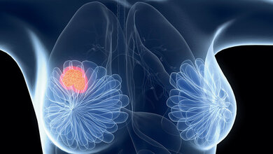 Labordiagnostik Spiegelbestimmung von Tamoxifen
und Metaboliten mittels LC-MS/MS