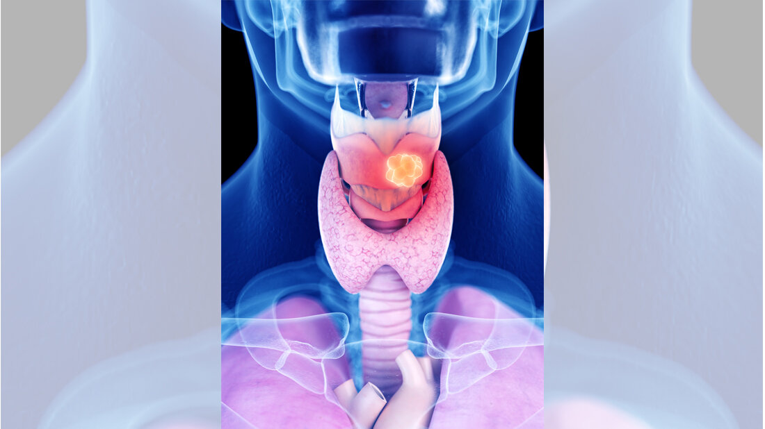 Tumoren im Kopf- und Halsbereich