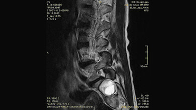 Schnittbilddiagnostik der Wirbelsäule (4.16)