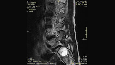 Tumoröse Veränderungen: Aneurysmatische Knochenzyste Schnittbilddiagnostik der Wirbelsäule (4.16)