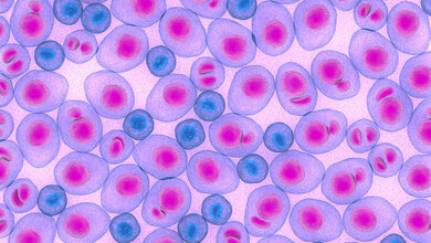 Multiples Myelom: Wer von welcher Immuntherapie profitiert