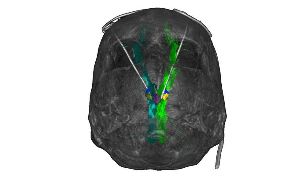 Tiefe Hirnstimulation