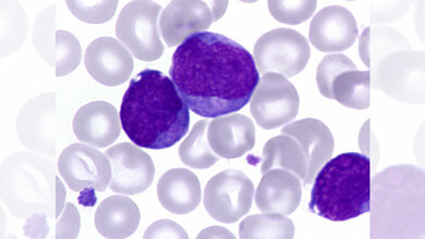 Blutausstrich einer Vorleukämie 