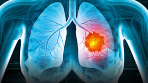 Transparente grafische Darstellung des Brustkorbs farblicher Hervorhebung eines Krankheitsherds in der Lunge