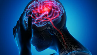 Katheterbehandlung nach schwerem Hirninfarrt erfolgereich