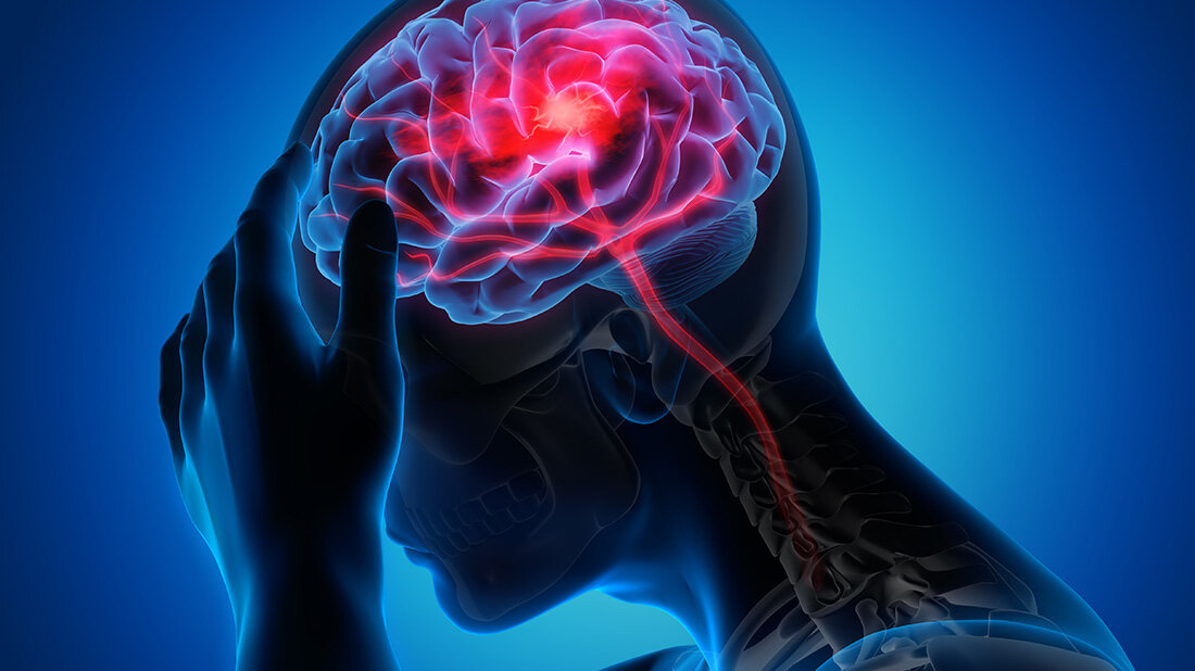 Katheterbehandlung nach schwerem Hirninfarrt erfolgereich