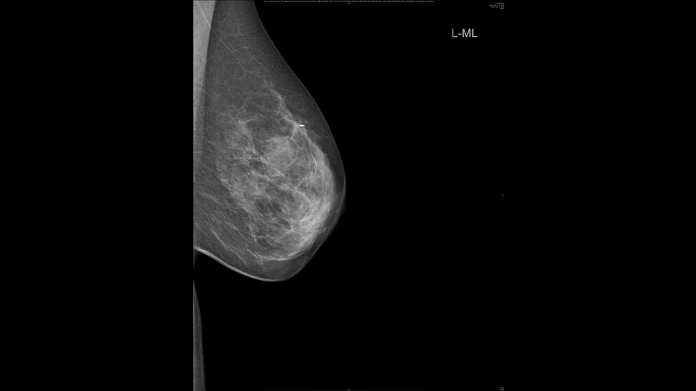 Mammografie-Aufnahme