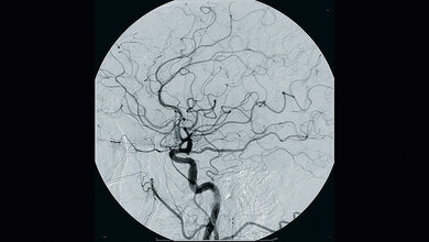 Digitale Subtraktionsangiographie (DSA)