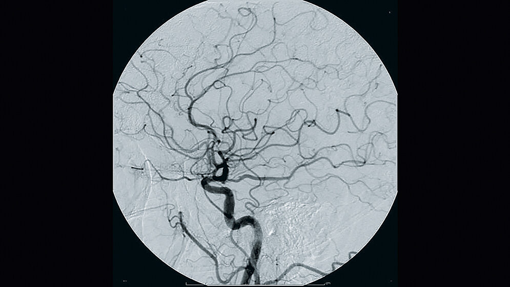 Digitale Subtraktionsangiographie (DSA)