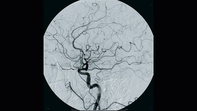Digitale Subtraktionsangiographie (DSA)