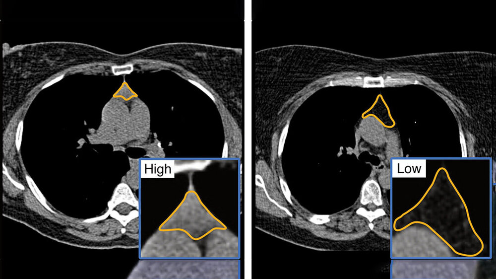 gesunderThymus.jpg CT-Aufnahmen zweier Brusträume, Fokus auf den Thymus