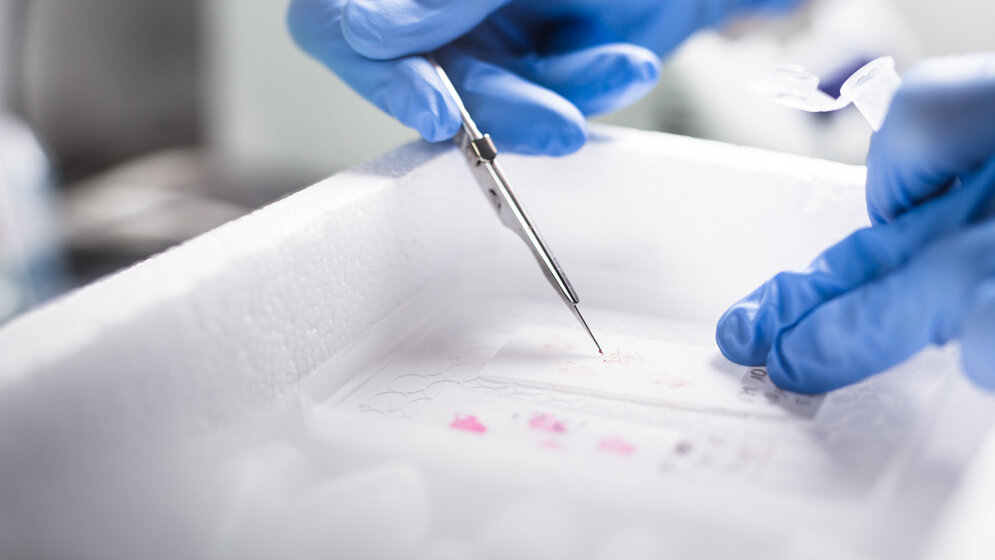 Aufarbeitung des Tumorgewebes