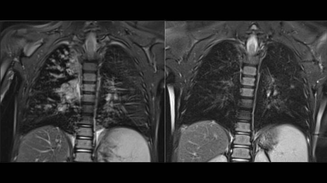 Mukoviszidose_Dreifachtherapie.jpg Mukoviszidose