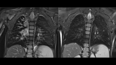 Mukoviszidose_Dreifachtherapie.jpg Mukoviszidose