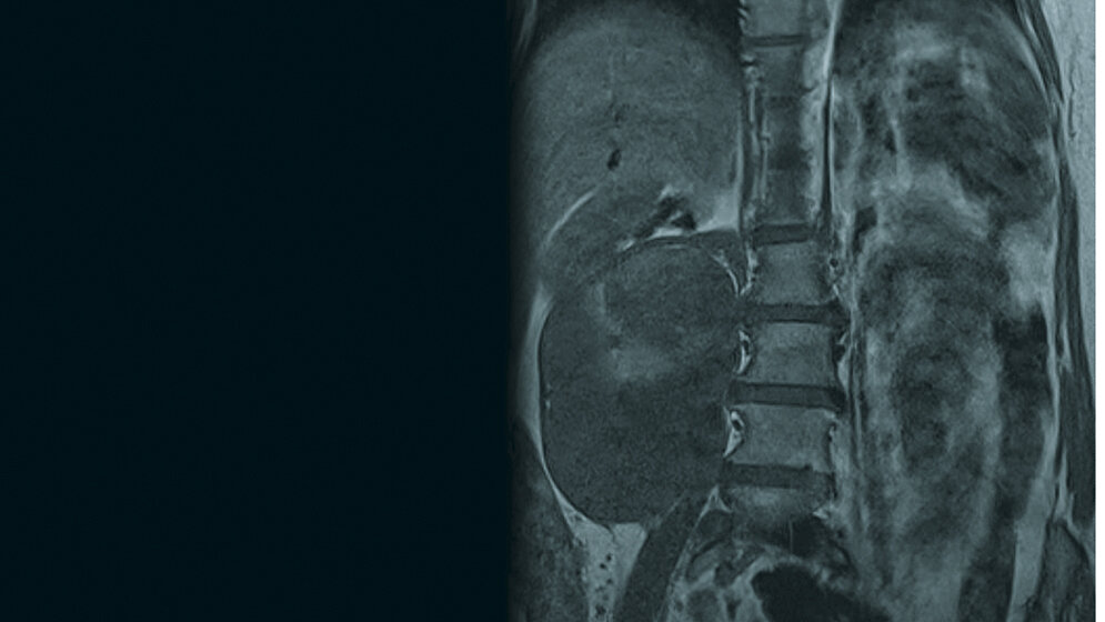 Zufallsbefunde: Retroperitoneales Liposarkom
