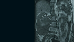 Zufallsbefunde: Retroperitoneales Liposarkom