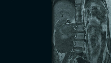 Zufallsbefunde: Retroperitoneales Liposarkom