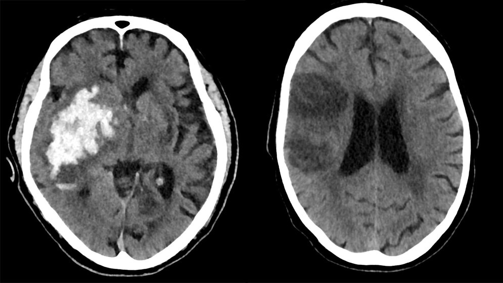CT-Aufnahmen des Gehirns von Personen mit Schlaganfall