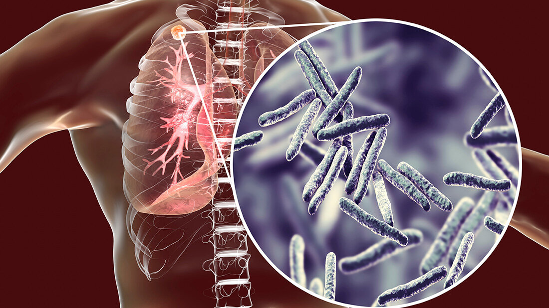 Leichter Anstieg der Tuberkulosefälle in Deutschland: Braucht es mehr Kontrollen?