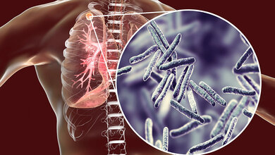 Leichter Anstieg der Tuberkulosefälle in Deutschland: Braucht es mehr Kontrollen?