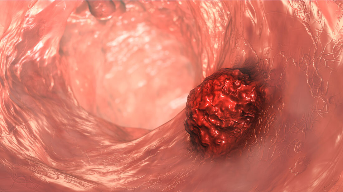 Darmkrebs_bei_Diabetes.jpg Schematische Darstellung eines Darmtumors.