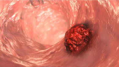 Darmkrebs_bei_Diabetes.jpg Schematische Darstellung eines Darmtumors.