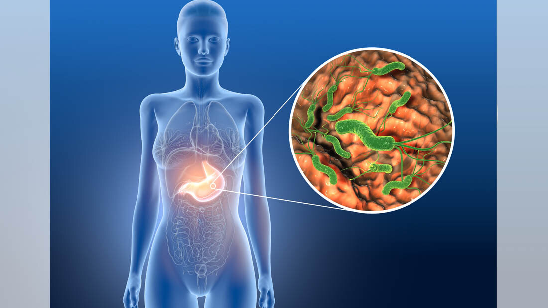 Helicobacter_pylori.jpg Symbolbild für Helicobacter pylori im Magen.