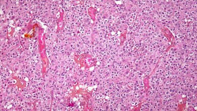 Oligodendroglioma_Von_Nephron_Eigenes_Werk_CC_BY_SA_3_0_11052016.jpg Oligodendrogliom