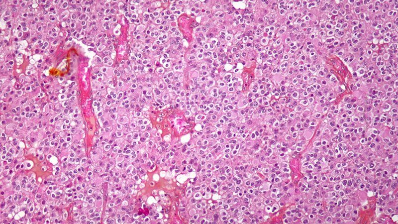Lebensverlängerung auch bei niedergradigen Gliomen MTDialog