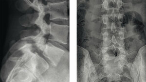 Skelettale Veränderungen 3.8: Spondylolyse